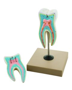 Eisco Labs Upper Triple Root Molar With Caries Model, Enlarged 15 Times, 2 Parts